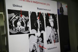 Современные возможности эндохирургии в лечении метастатического рака толстой кишки