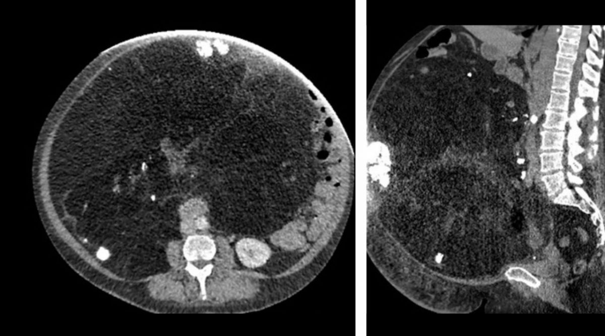 Гигантскую злокачественную опухоль весом 22 кг удалили в Первой онкологической больнице Москвы – Клинический случай